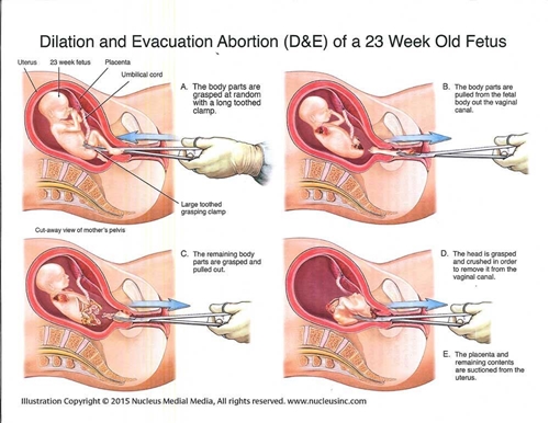 Picture of Dilation and Evacuation Abortion Diagram
